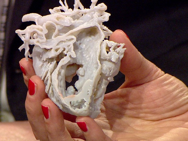 Médicos usam coração feito em impressora 3D em cirurgia de criança 